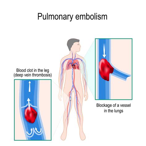 embolism definition medical